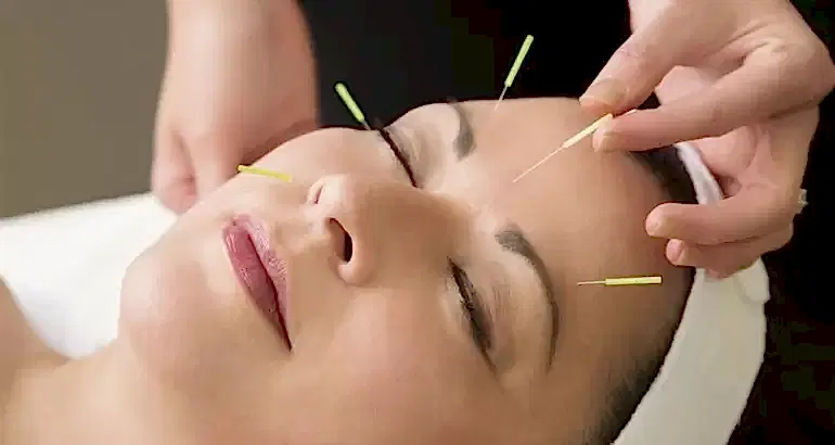 Kozmetik Akupunktur Nedir?