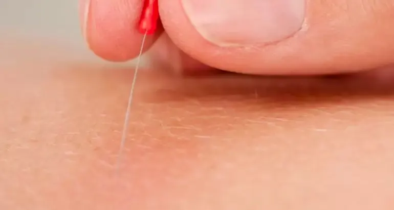 Kuru İğne Uygulaması