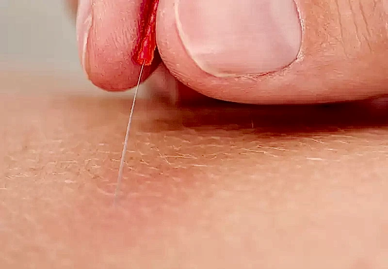 Kuru İğne Uygulaması