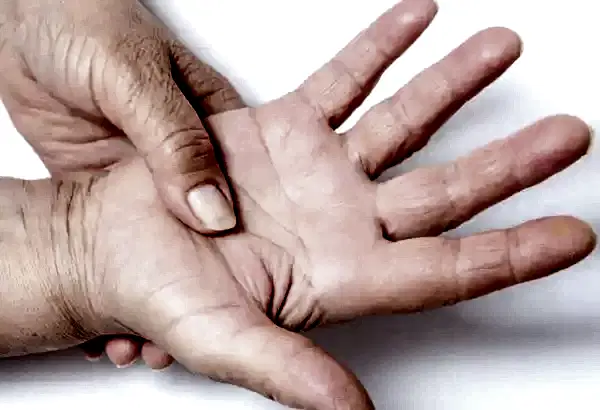 El Terlemesinde Anestezi