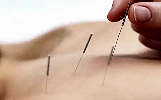 Akupunktur İle Boyun Ağrısı Tedavisi