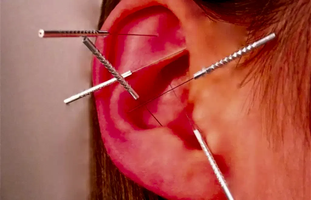 Akupunktur İle Zayıflama Tedavisi