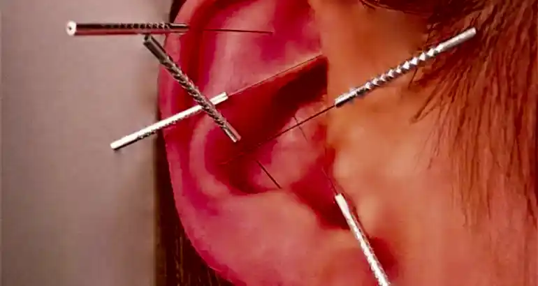 Akupunktur İle Zayıflama Tedavisi