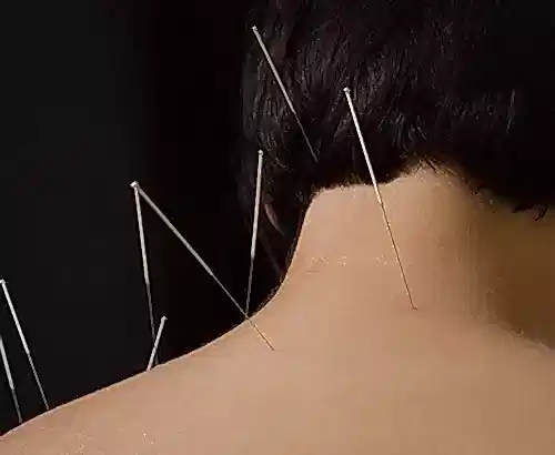 Akupunktur İle Boyun  Fıtığı Tedavisi