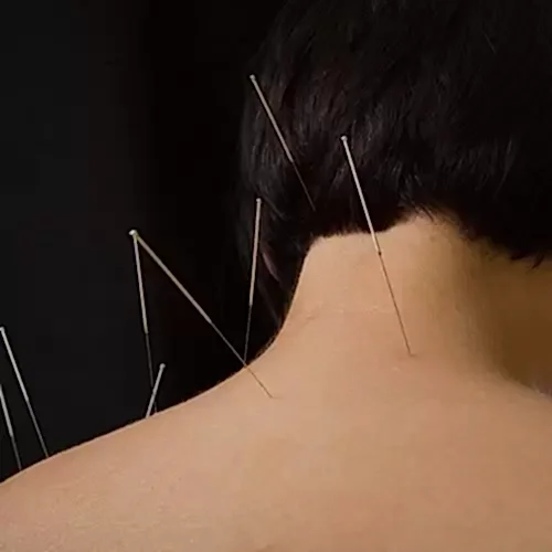 Akupunktur İle Boyun  Fıtığı Tedavisi