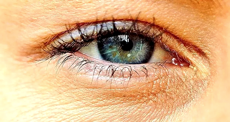 Ozon ile Sarı Nokta (Makula Dejenerasyonu) Tedavisi