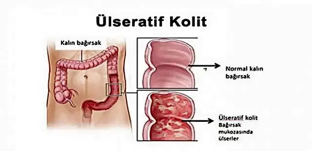 Ülseratif Kolit ve Bağırsak Florası