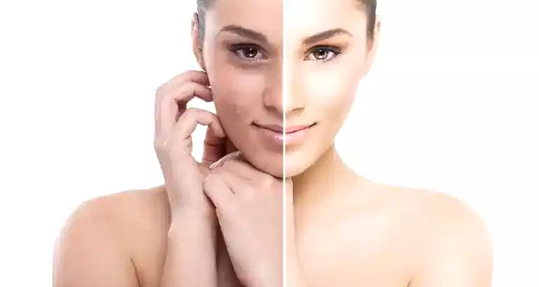 Akne Tedavisinde Mezoterapi