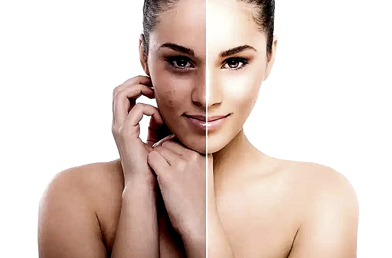 Akne Nedir ? Nasıl Tedavi Edilir ?