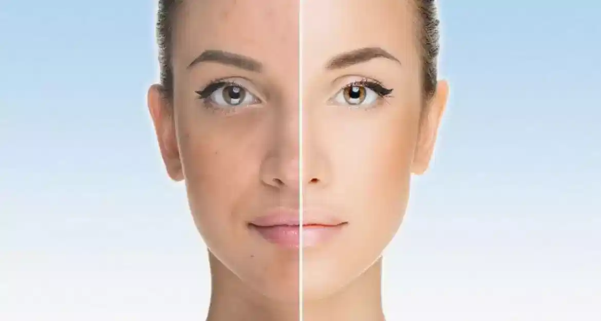 Akne ve Akne İzi Tedavisinde Mezoterapi