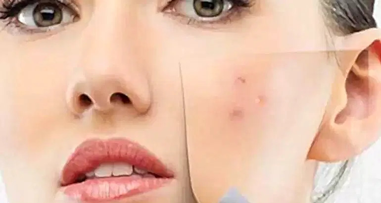 Leke Tedavisinde Mezoterapi