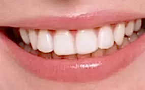 Gummy Smile Tedavisi