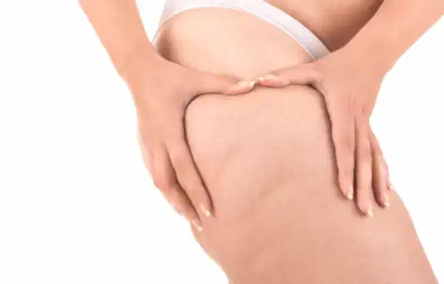 Selülit Tedavisinde Mezoterapi