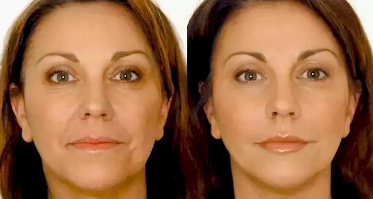 Sigaranın Cilde Zararları