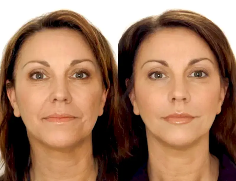 Sigaranın Cilde Zararları