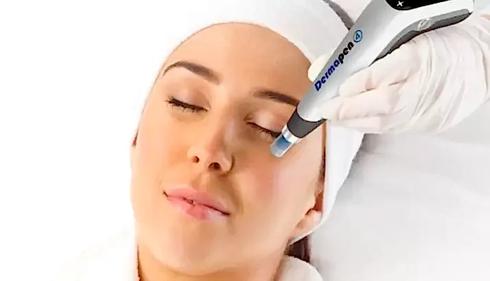 Cilt Gençleştirmede Mikroneedling (Dermapen)