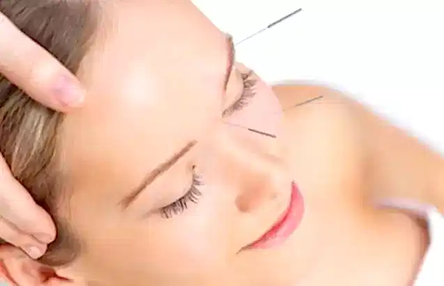 Cilt Gençleştirmede Kozmetik Akupunktur