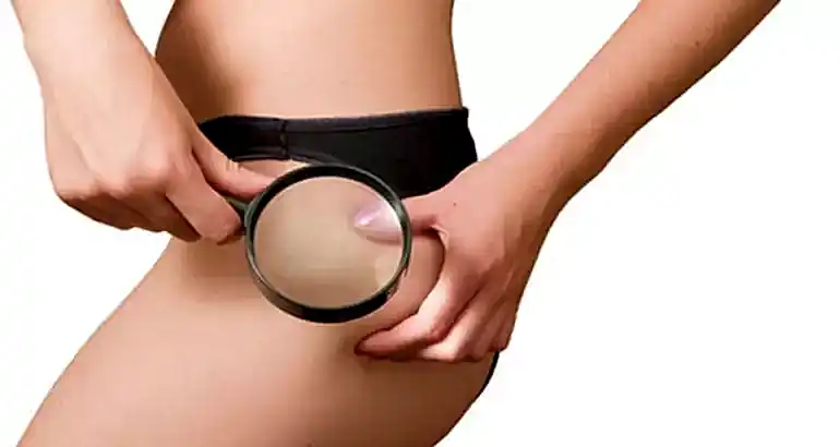 Selülit Tedavisinde Ozon Terapi